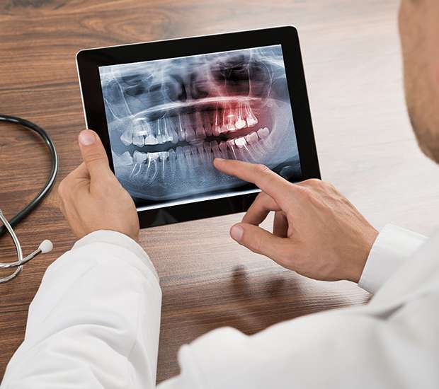 Union Types of Dental Root Fractures